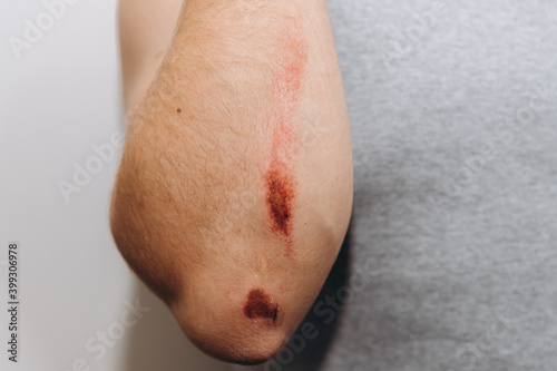 Photos Large abrasions on the forearm of a man after a fall.