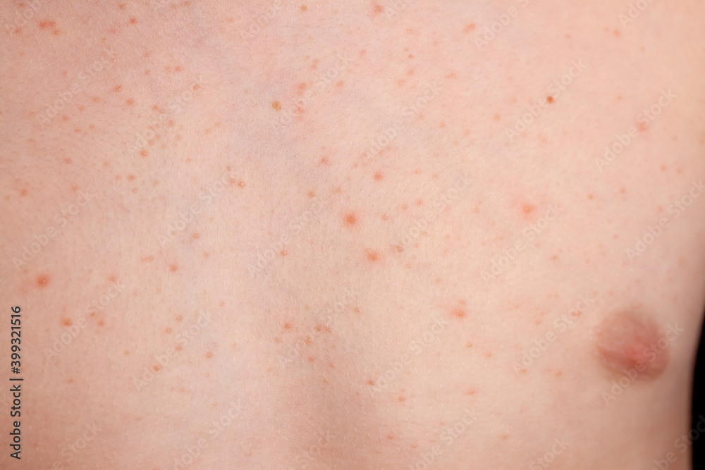 Close up image of a little boy's body suffering severe urticaria, nettle rash also called hives Close up image of a little boy's body suffering severe urticaria, nettle rash also called hives