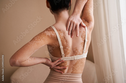 Woman posing against beige wall having vitiligo skin photo