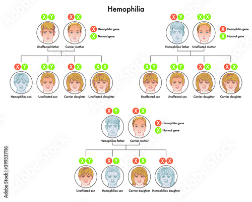 Diagram shows that healthy carrier children or with hemophilia are the consequence of a genetic alteration of the X chromosome transmitted to them by their parents.
