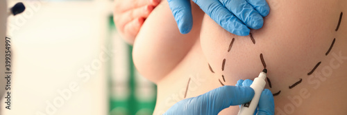 Close up of male doctor hands in sterile gloves drawing marks on female body for plastic surgery