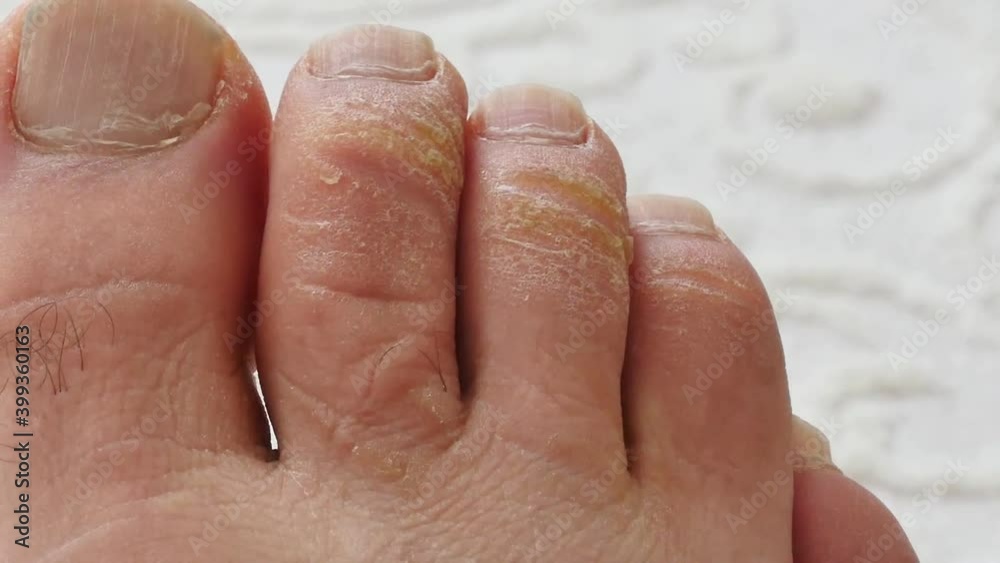 itching in the fingers, fungal infection, closeup fungal infection in the toes, Stock ビデオ