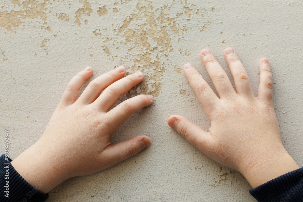Hands of a child with signs of allergic dermatosis on a light wooden
