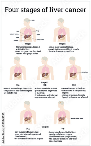 Four stages of liver cancer and five substages with a brief description of each