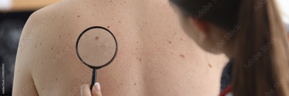Fototapeta premium Oncologist holds magnifying glass in hand and examines pigmented nevi on patient's back in clinic. Diagnosis of malignant skin tumors concept.