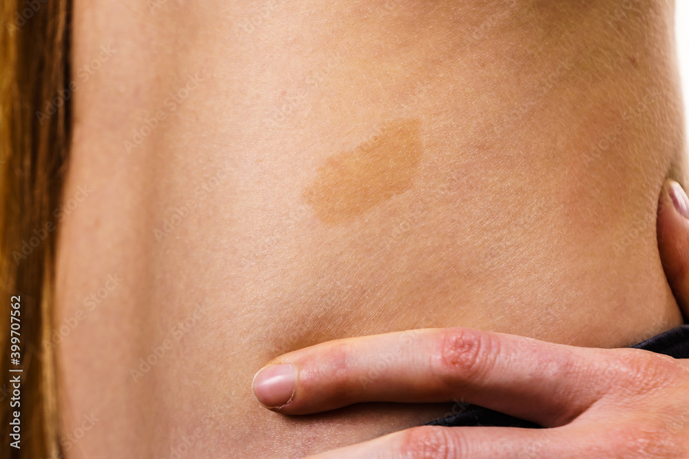 Closeup of brown birthmark on skin Closeup of brown birthmark on skin