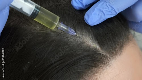 Doctor trichologist making injections mesotherapy with vitamins in woman skin head for hair growth and against dandruff in cosmetology clinic, closeup view. Hairs cure. Trichology in medicine. photo