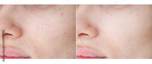 
laser removal of freckles and age spots. before and after photos photo