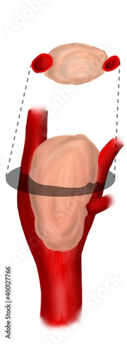 carotid body tumor iis rare paraganglioma presented with neck mass.. this demonstareted Shamblin classification  photo