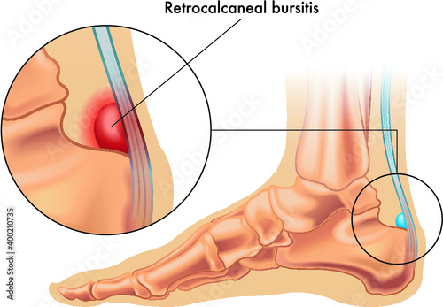 Illustration showing the position of the normal retrocalcaneal bursa in the foot, and in enlarged detail a retrocalcaneal bursitis, annotated on white.