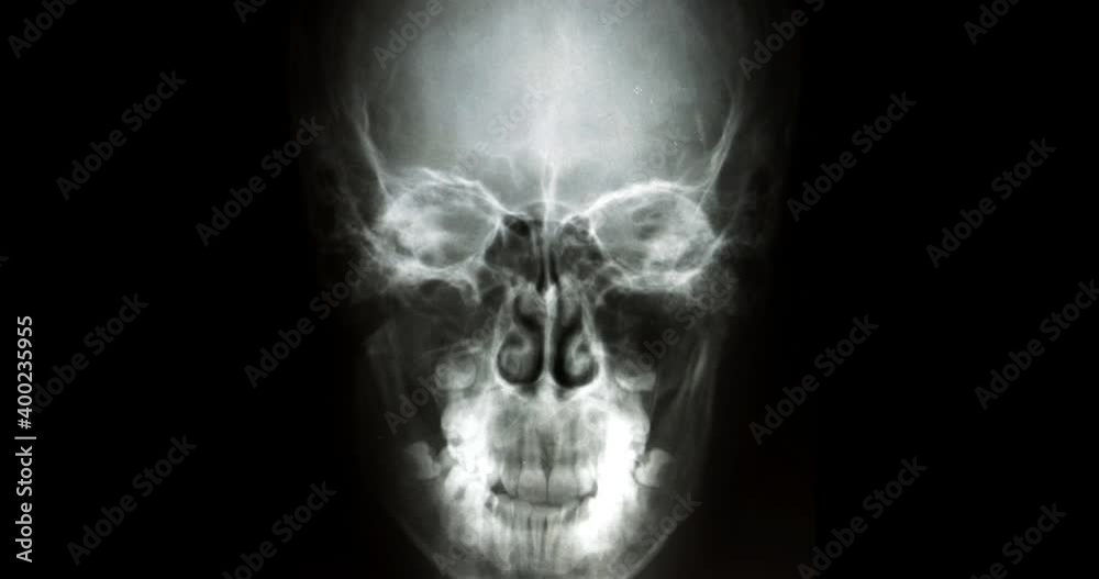 Zoom-in X-ray of a human skull, human bones. 4K Zoom-in X-ray of a human skull, human bones. 4K