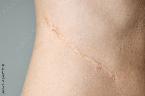 Obraz na plátně surgery scar after kidney pyelonephritis