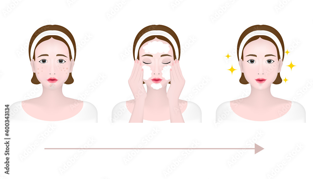 Portrait of a woman before, during and after cleansing the facial skin,Blackhead, Whitehead, Papule, Pustule, Skin problems Portrait of a woman before, during and after cleansing the facial skin,Blackhead, Whitehead, Papule, Pustule, Skin problems