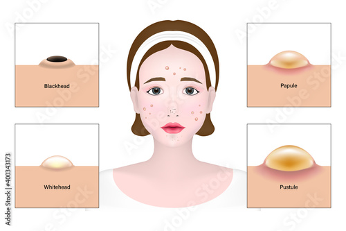 Women and types of acne, Skin problems vector, Blackhead, Whitehead, Papule, Pustule
