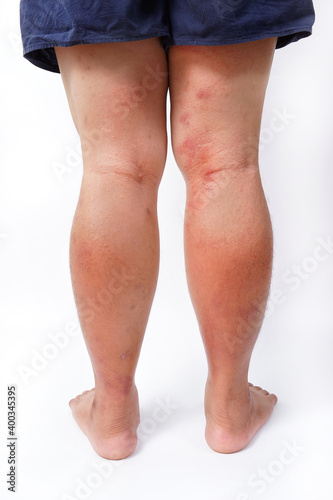 A close-up of bad psoriasis on a person's leg. Eczema allergy skin, dermatologic diseases. 