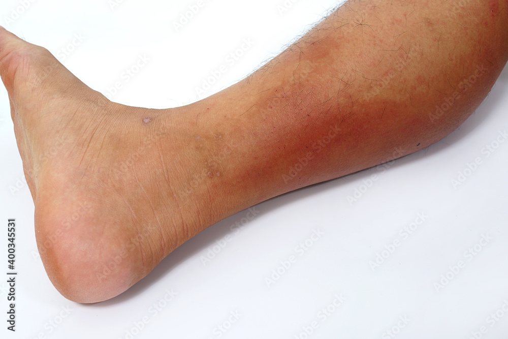 A close-up of bad psoriasis on a person's leg. Eczema allergy skin, dermatologic diseases. A close-up of bad psoriasis on a person's leg. Eczema allergy skin, dermatologic diseases.
