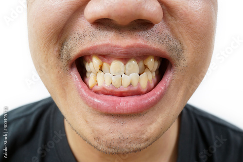 Young Asian man is showing his dirty teeth with plaque build-up