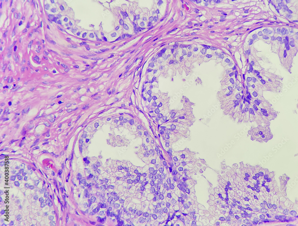 Photo of prostatic acini in patient with benign prostatic hyperplasia, photo under microscope