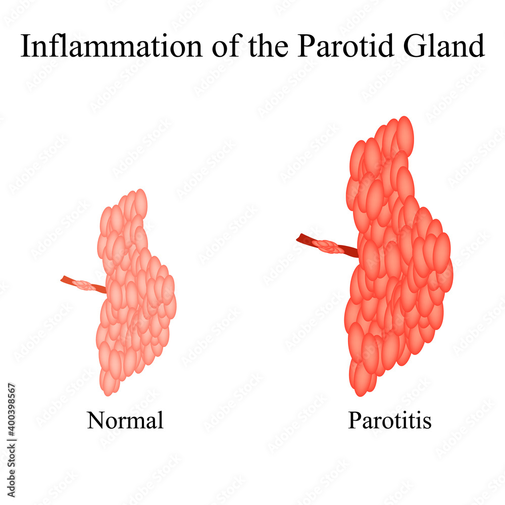 Inflammation of the parotid gland.The structure of the parotid salivary