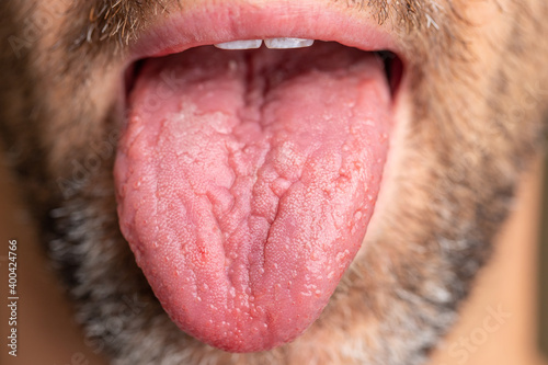 A white male with brown and white facial hair. Tongue is sticking out to show geographic tongue, also known as benign migratory glossitis where lines form and can cause pain or discomfort.