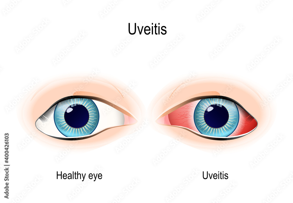 Uveitis. inflammation eye Adobe Stock