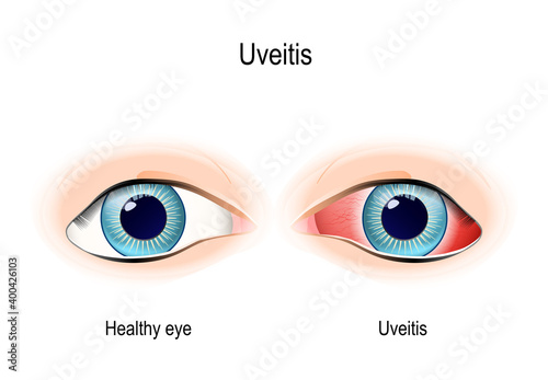 Uveitis. inflammation eye