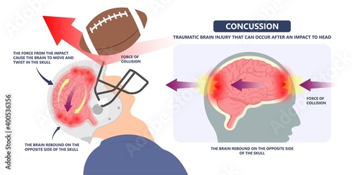 Brain Injury mild post head bleed sport loss second bump blow jolt hit skull ear contact hockey trauma fall pain athlete ball  rugby play 