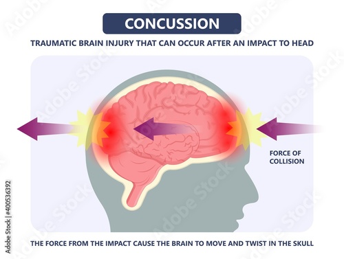 Brain Injury mild post head bleed sport loss second bump blow jolt hit skull ear contact hockey trauma fall pain athlete ball  rugby play 