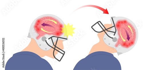 Brain Injury mild post head bleed sport loss second bump blow jolt hit skull ear contact hockey trauma fall pain athlete ball  rugby play 