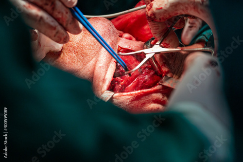 Emergency carotid artery surgery on both sides in hospital photo