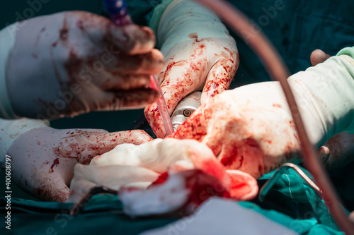 Surgical hands with blood during the surgery in hospital