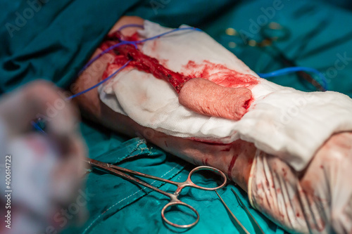 Radial forearm free flap microvascular surgery in hospital photo