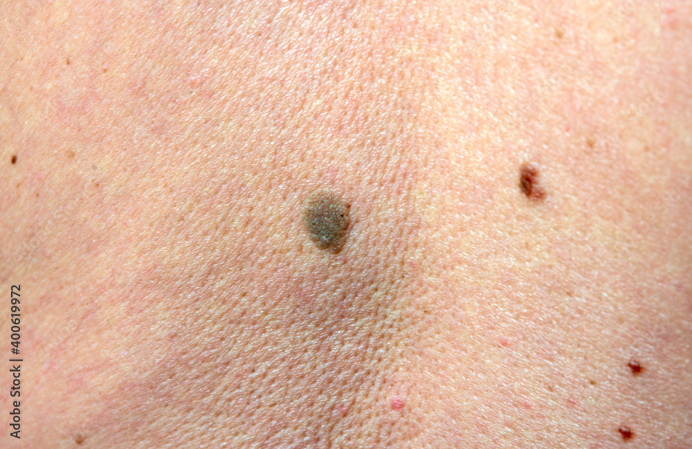 close up the black spot on human back skin. Melanoma is a type of skin  cancer develops on human skin from the pigment-producing cells melanocytes.  Risk to be skin cancer. Photos