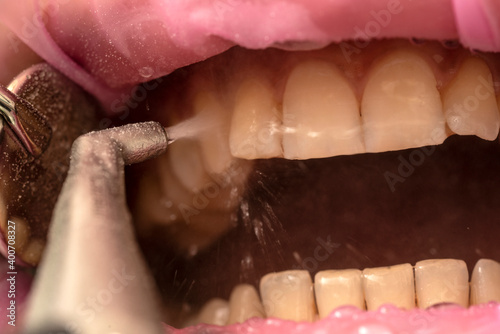 Tableau sur toile teeth sandblasting, tartar cleaning and whitening