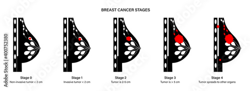Breast disease concept