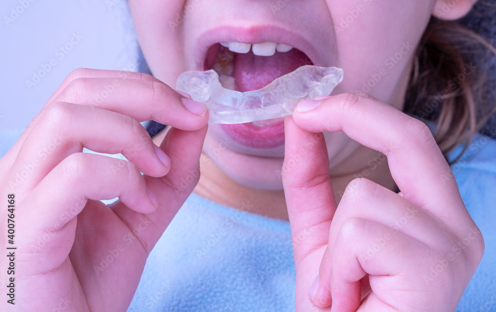 CAUCASIAN GIRL HOLDING AN OCCLUSAL SPLINT. TEETH GRINDING THERAPY