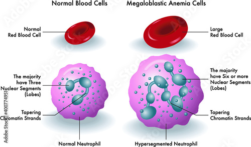 Medical illustration shows the difference between normal blood cells and megaloblastic anemia cells.