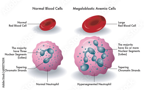 Medical illustration shows the difference between normal blood cells and megaloblastic anemia cells.