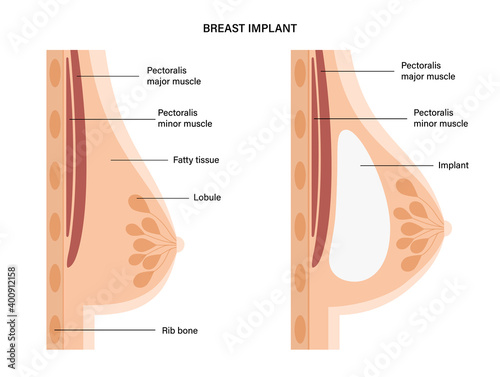 Breast Implant Concept