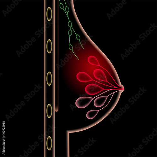 Breast disease concept