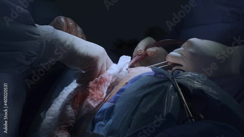 Thoracic surgeons performing a left lower lobe lung surgery. Medical themes photo