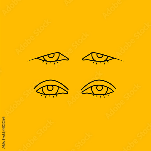 Upper eyelid blepharoplasty before and after, comparison