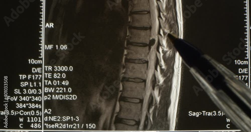 A Sagittal View Magnetic Resonance Image or MRI of Lumbar Spine Showing Ruptured Intervertebral Disc Herniation