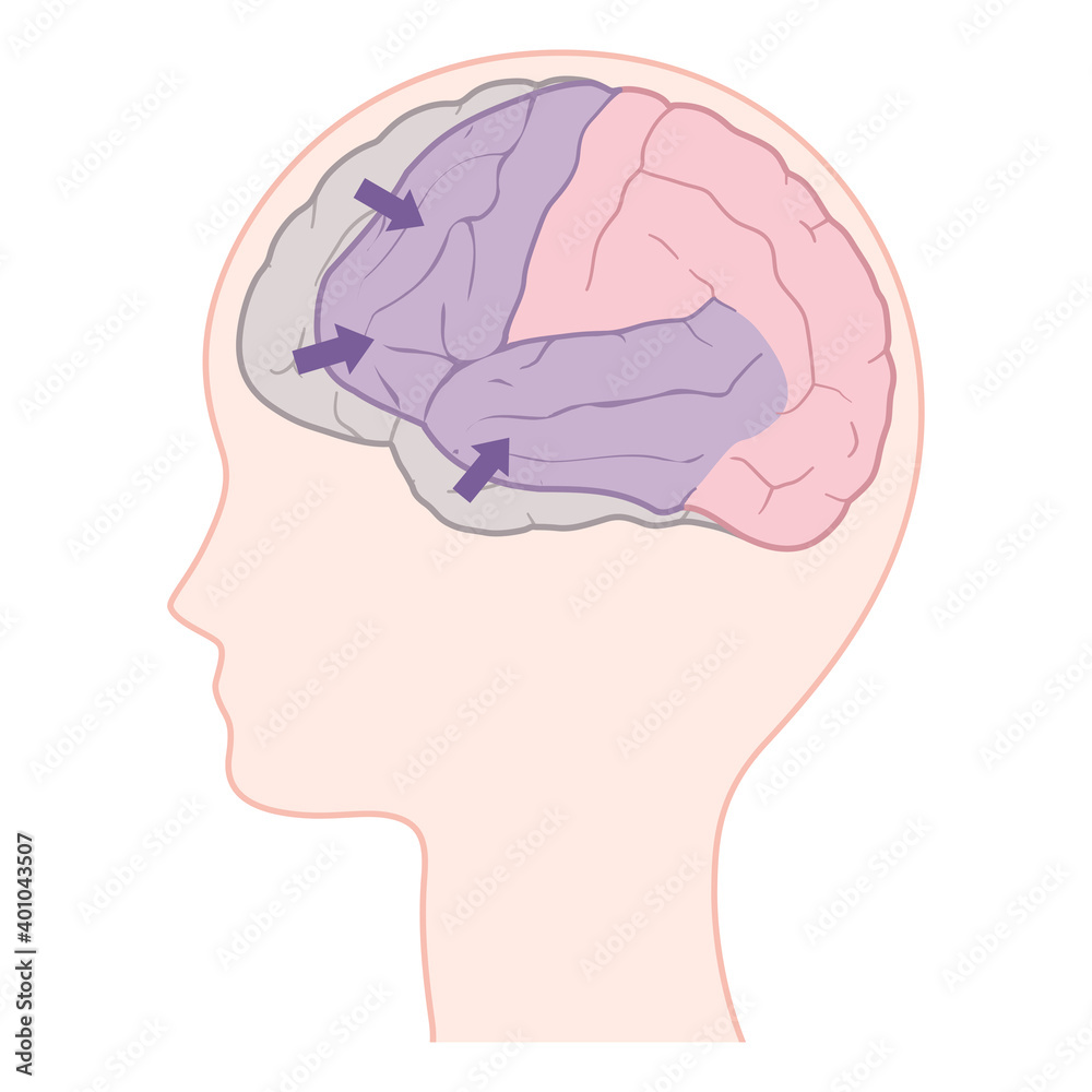 前頭側頭型認知症の脳のイラスト_前頭葉と側頭葉の萎縮 前頭側頭型認知症の脳のイラスト_前頭葉と側頭葉の萎縮