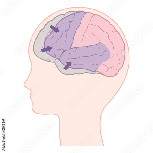 前頭側頭型認知症の脳のイラスト_前頭葉と側頭葉の萎縮