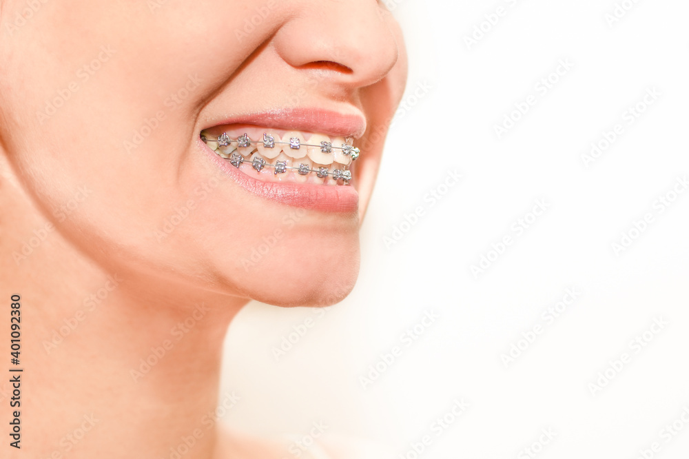 Fototapeta premium Closeup of woman with braces on teeth. Smiling face with braces isolated on white background. Orthodontic treatment concept. Closeup of healthy female mouth with metal braces.