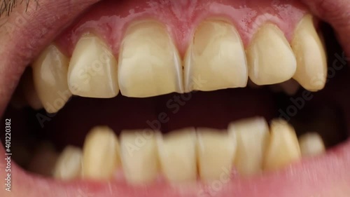 man clenches closes and grits his teeth, erased tooth enamel, dental wedge-shaped defect or V-shaped notches, front view