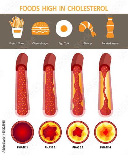 Cholesterol in artery, health risk , vector design, foods high in cholesterol