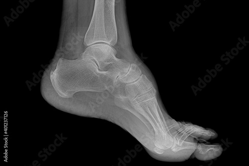Foot radiography of a hospital patient