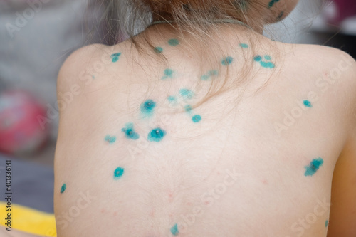 Child covered with green rashes the whole body ill with chickenpox, measles or rubella virus. Varicella. Infectious viral skin disease.Sick little girl with varicells making eruption on skin photo